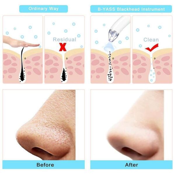 Derma Suction Pore Cleaning Device- AG00005978 - Image 3